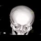 Depression fracture of the skull: CT - Computed tomography